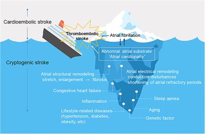 Atrial Cardiopathy and Cryptogenic Stroke